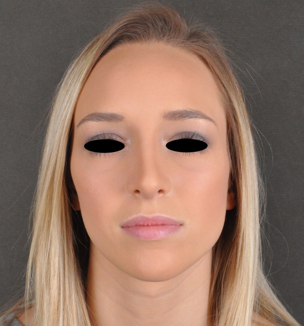 rhinoplasty - patient 9931 - after 1 rhinoplasty - patient 9931 - after 1