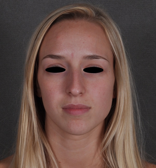 rhinoplasty - patient 9931 - before 1 rhinoplasty - patient 9931 - before 1