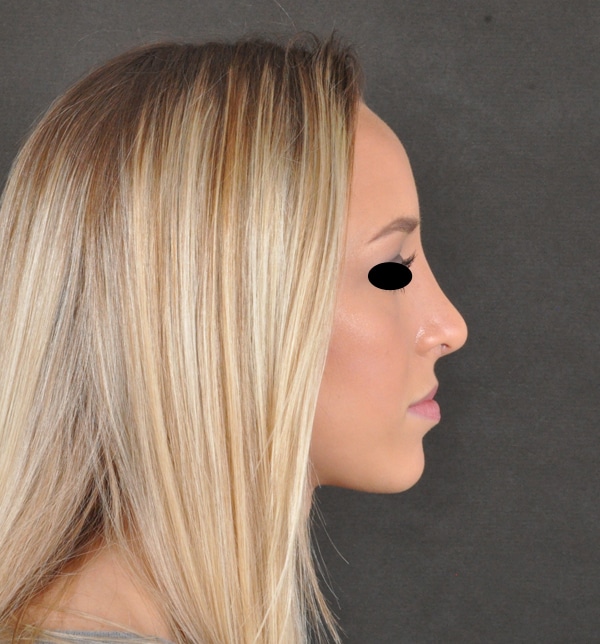 rhinoplasty - patient 9931 - after 3 rhinoplasty - patient 9931 - after 3