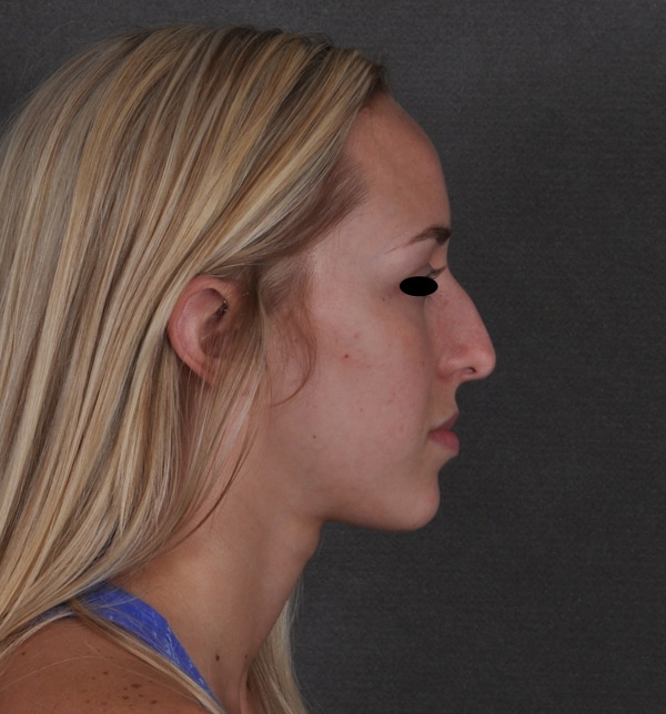 rhinoplasty - patient 9931 - before 3 rhinoplasty - patient 9931 - before 3