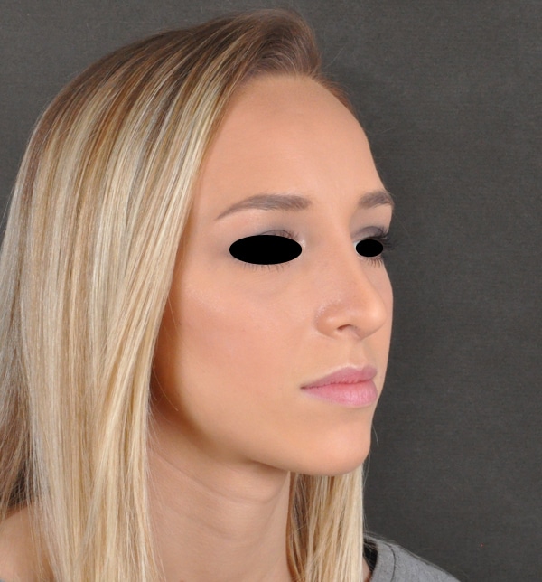 rhinoplasty - patient 9931 - after 2 rhinoplasty - patient 9931 - after 2