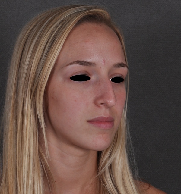 rhinoplasty - patient 9931 - before 2 rhinoplasty - patient 9931 - before 2