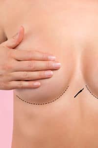 Breast Lift Scar Placement
