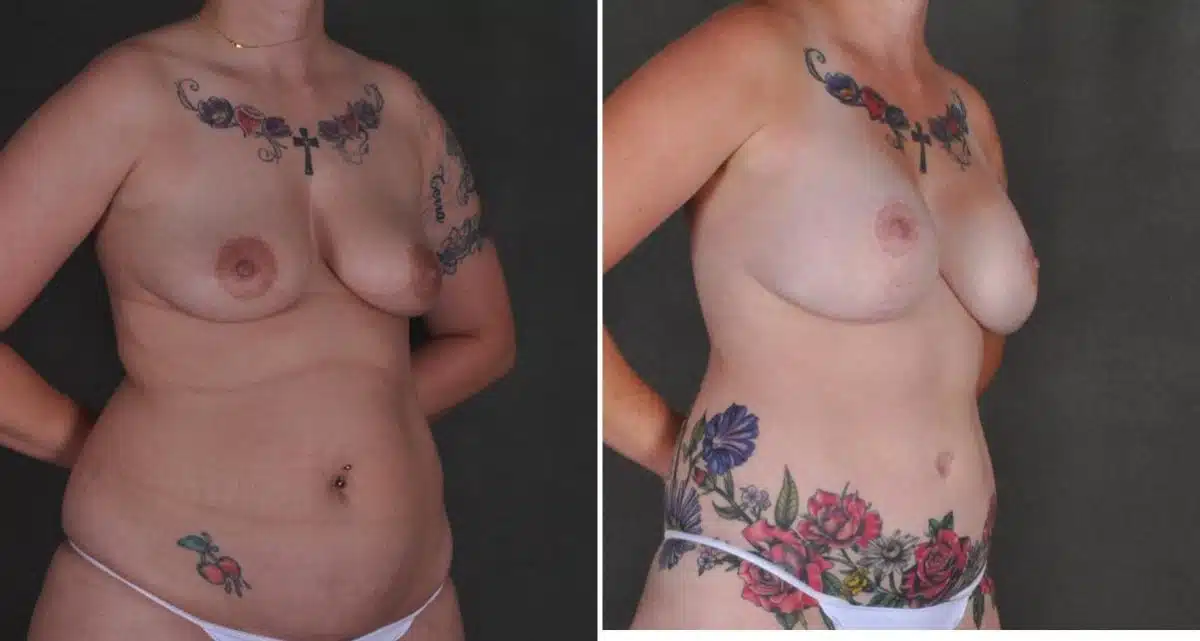 Breast Augmentation Before and After Photos in Omaha, NE, Case 10443