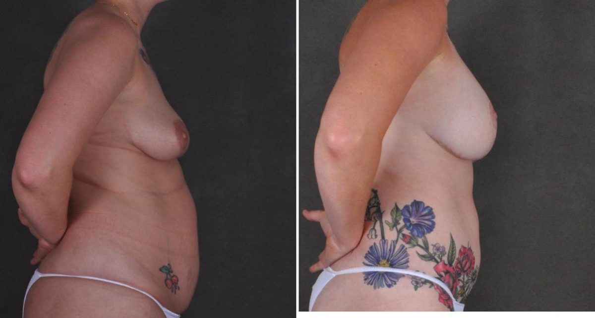 Breast Augmentation Before and After Photos in Omaha, NE, Case 10443