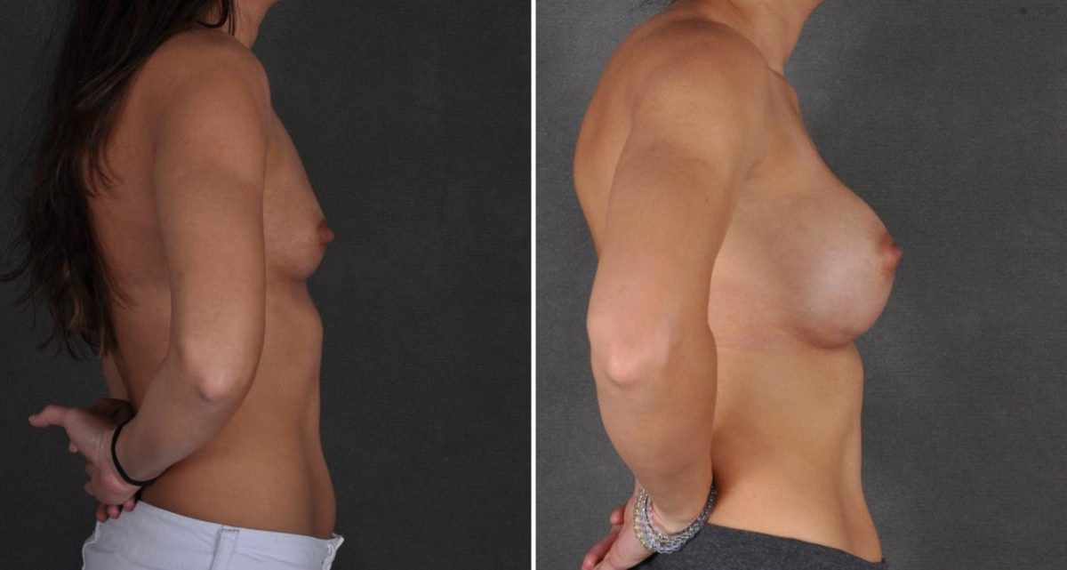 Breast Augmentation Before and After Photos in Omaha, NE, Case 10469