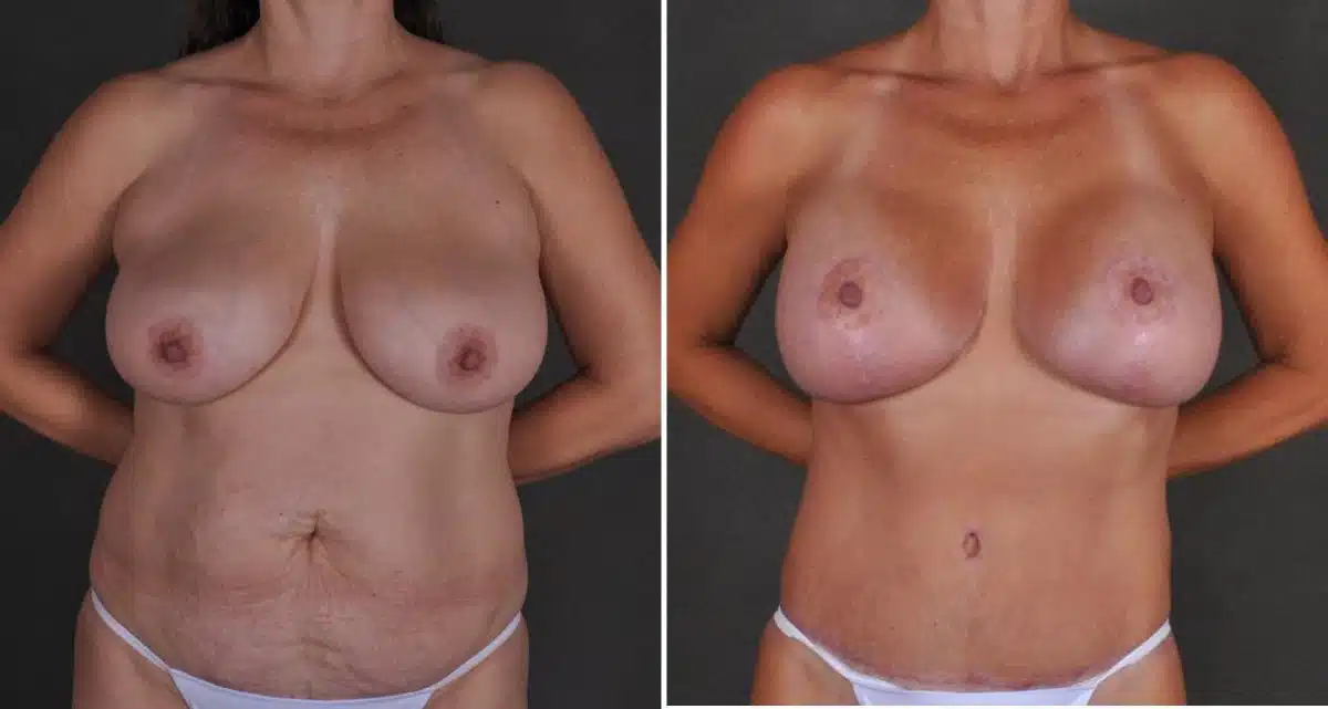 Breast Augmentation Before and After Photos in Omaha, NE, Case 10514