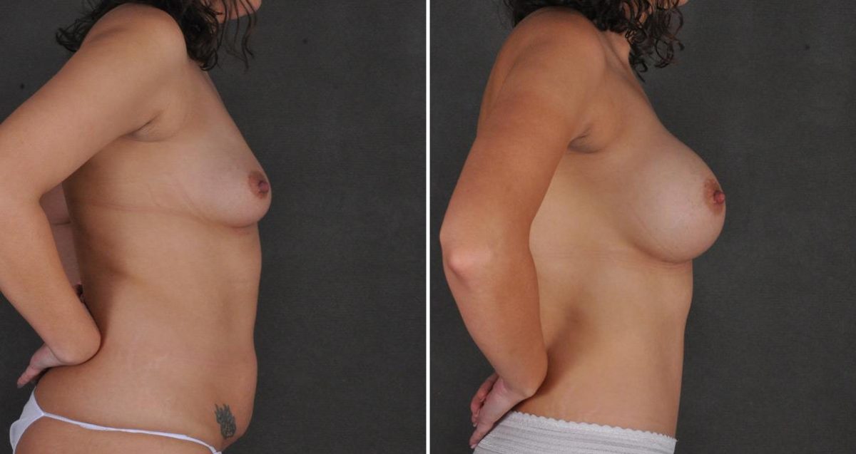 Breast Augmentation Before and After Photos in Omaha, NE, Case 10385