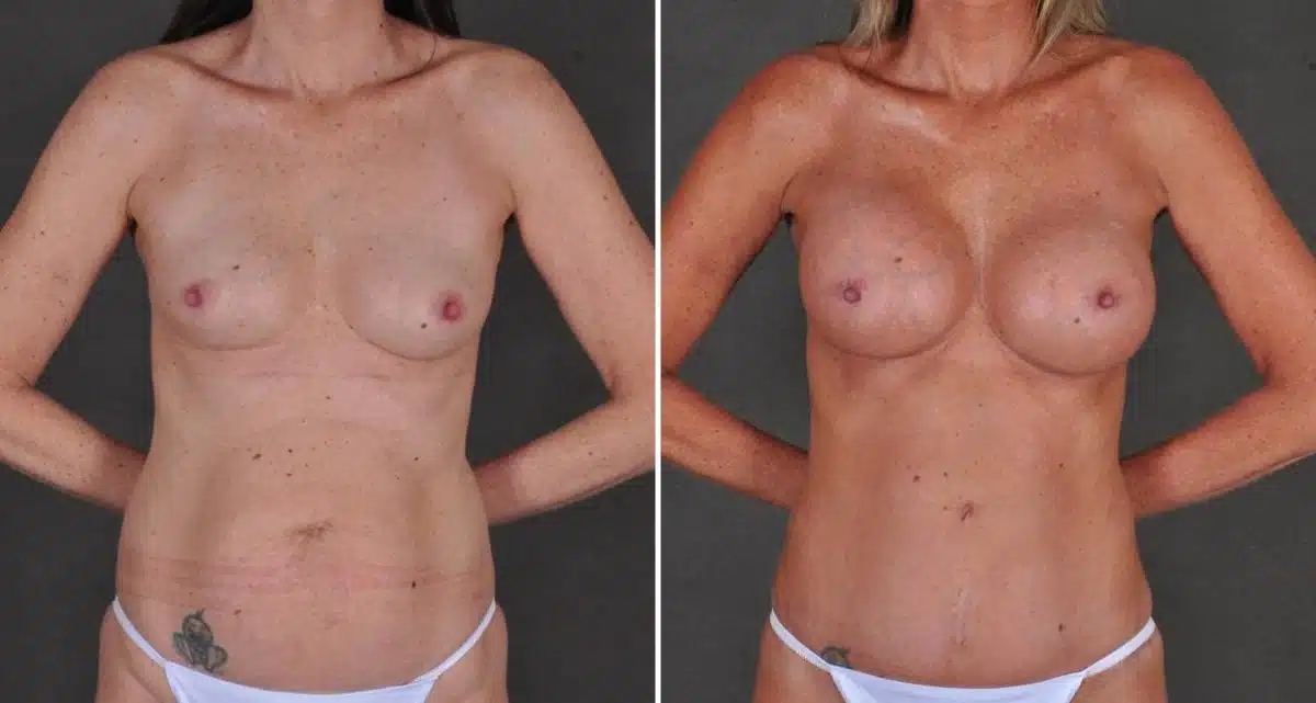 Breast Augmentation Before and After Photos in Omaha, NE, Case 10407