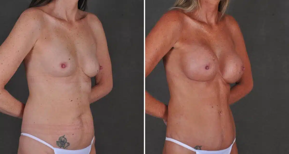 Breast Augmentation Before and After Photos in Omaha, NE, Case 10407