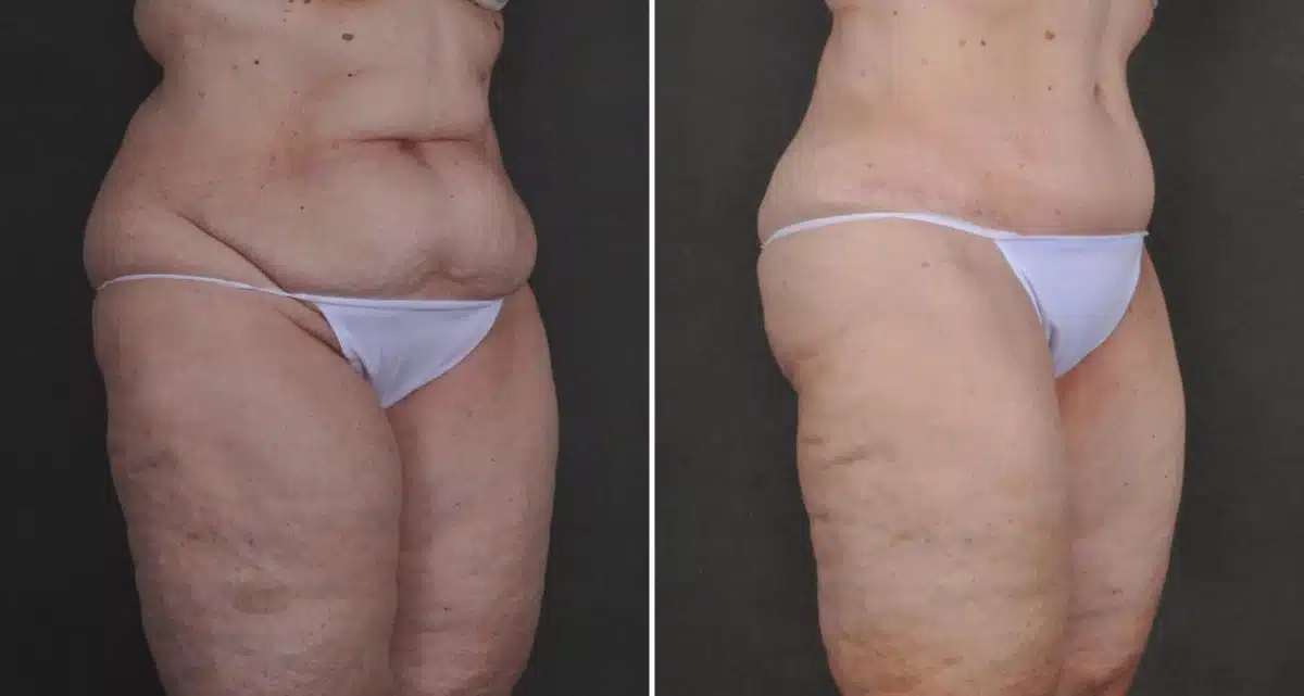 Liposuction Before and After Photos in Omaha, NE, Case 10480