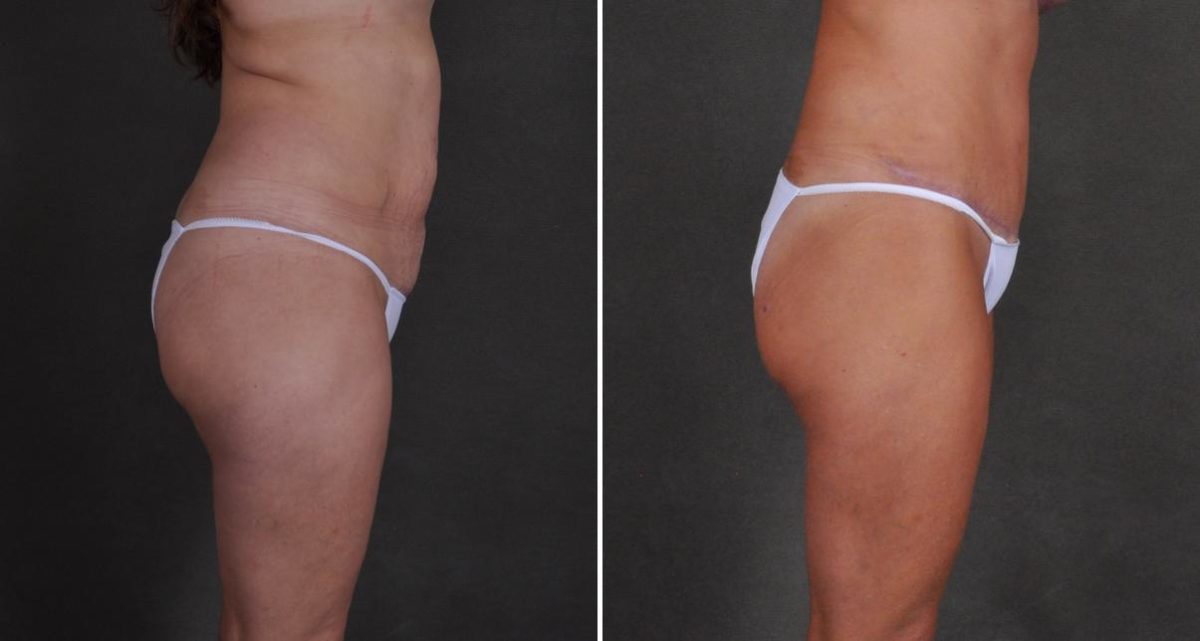 Liposuction Before and After Photos in Omaha, NE, Case 10515