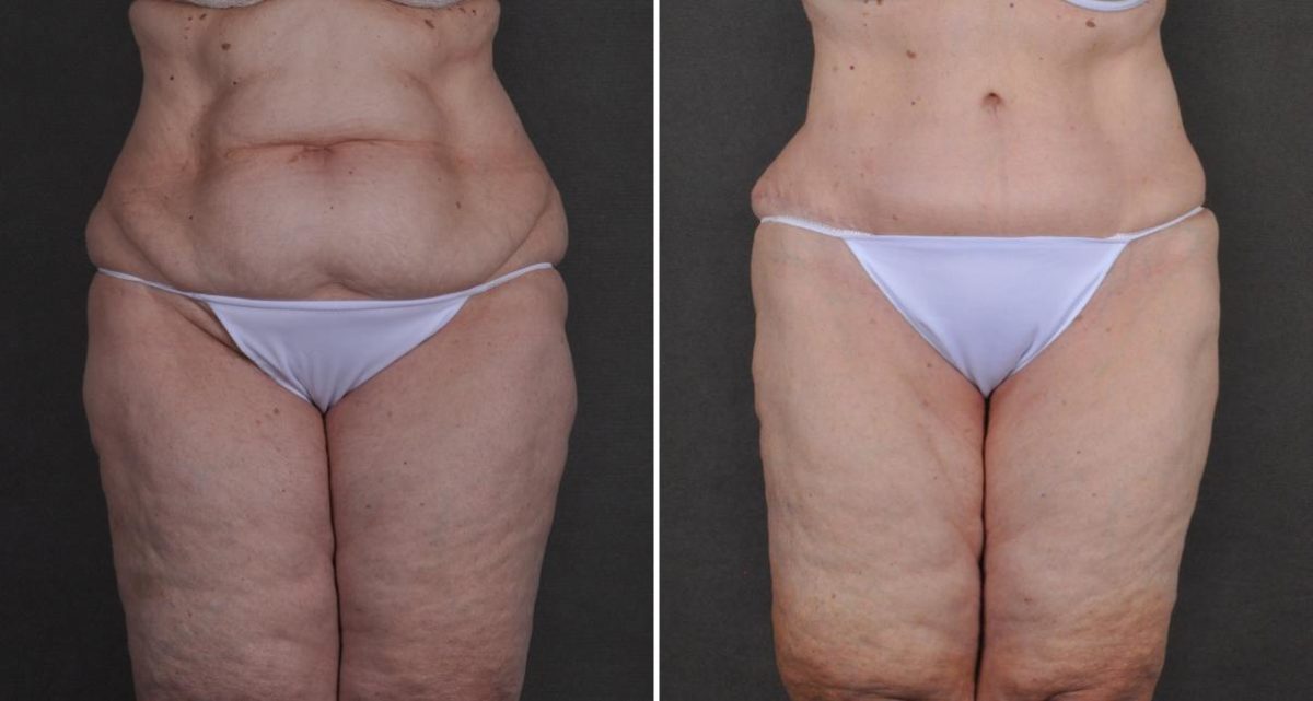 Liposuction Before and After Photos in Omaha, NE, Case 10480