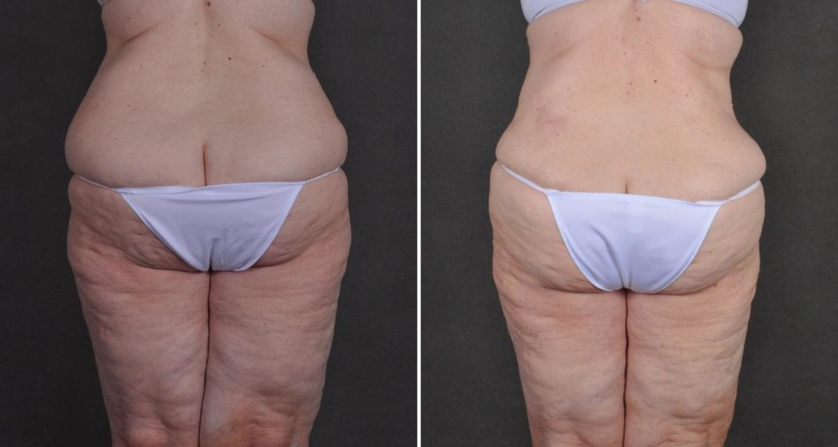 Liposuction Before and After Photos in Omaha, NE, Case 10480