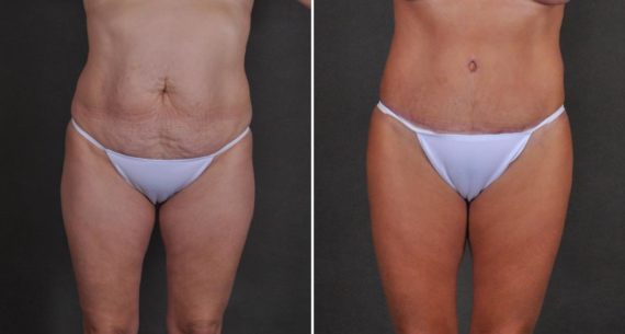 Liposuction Before and After Photos in Omaha, NE, Case 10515