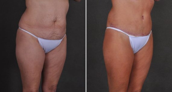 Liposuction Before and After Photos in Omaha, NE, Case 10515