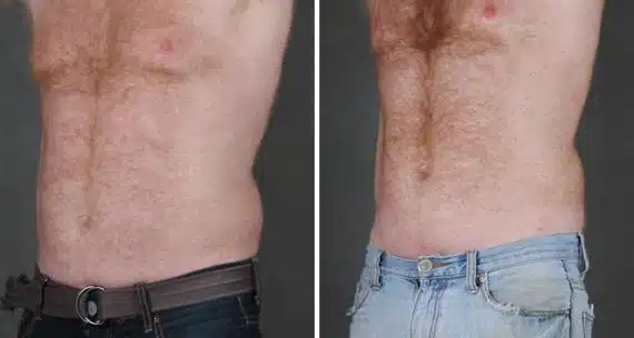 CoolSculpting Before and After Photos in Omaha, NE, Case 3643