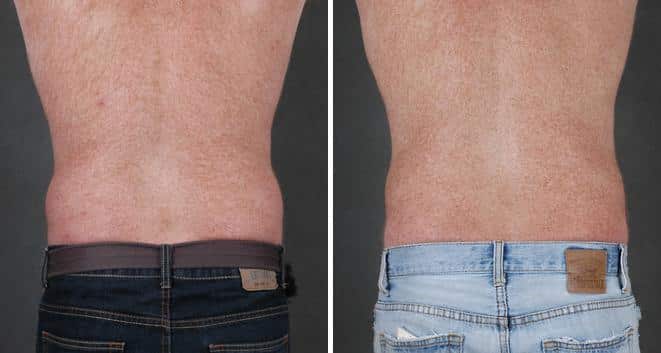 CoolSculpting Before and After Photos in Omaha, NE, Case 3643