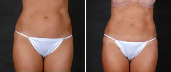 CoolSculpting Before and After Photos in Omaha, NE, Case 3653