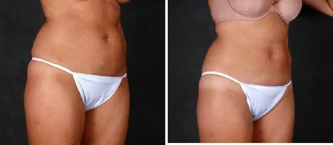 CoolSculpting Before and After Photos in Omaha, NE, Case 3653