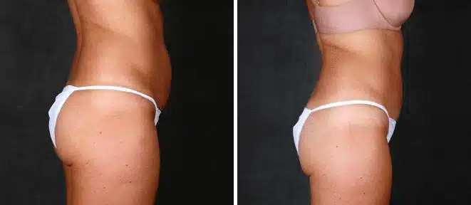 CoolSculpting Before and After Photos in Omaha, NE, Case 3653