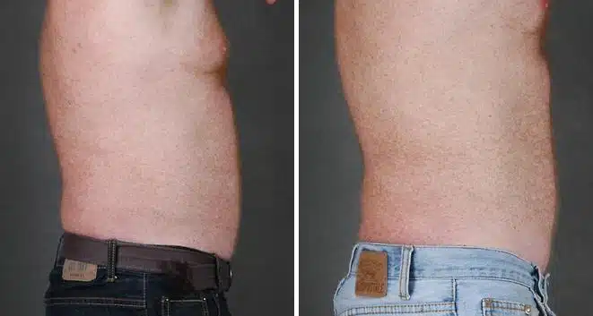 CoolSculpting Before and After Photos in Omaha, NE, Case 3643