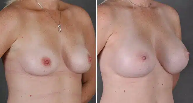 Breast Augmentation Before and After Photos in Omaha, NE, Case 3689