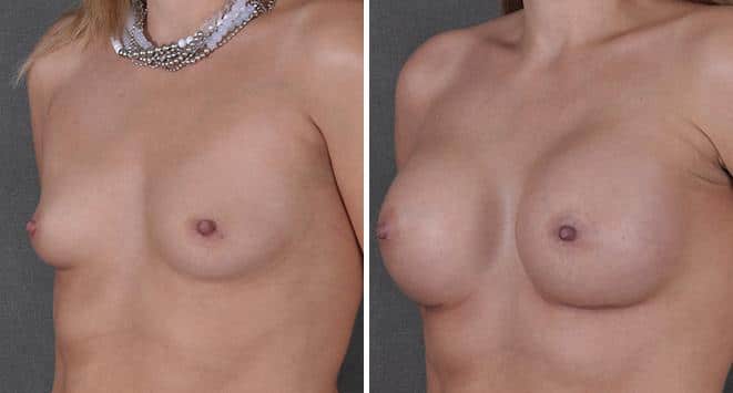 Breast Augmentation Before and After Photos in Omaha, NE, Case 3697