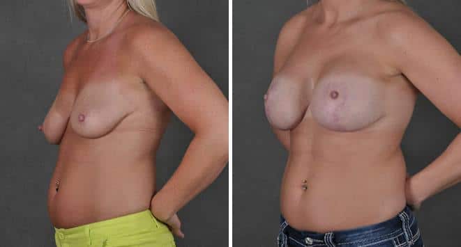 Breast Augmentation Before and After Photos in Omaha, NE, Case 3717