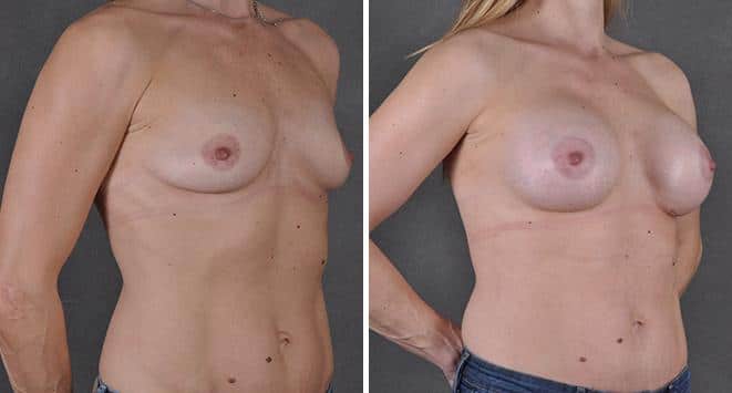 Breast Augmentation Before and After Photos in Omaha, NE, Case 3667