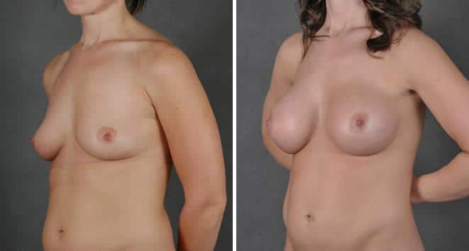 Breast Augmentation Before and After Photos in Omaha, NE, Case 3731