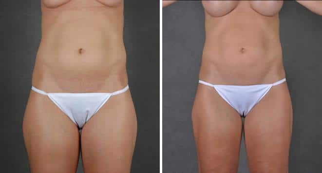 Breast Augmentation Before and After Photos in Omaha, NE, Case 3731