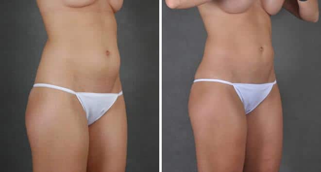 Breast Augmentation Before and After Photos in Omaha, NE, Case 3731