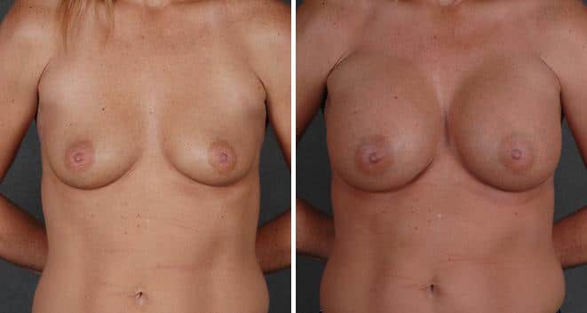 Breast Augmentation Before and After Photos in Omaha, NE, Case 3785