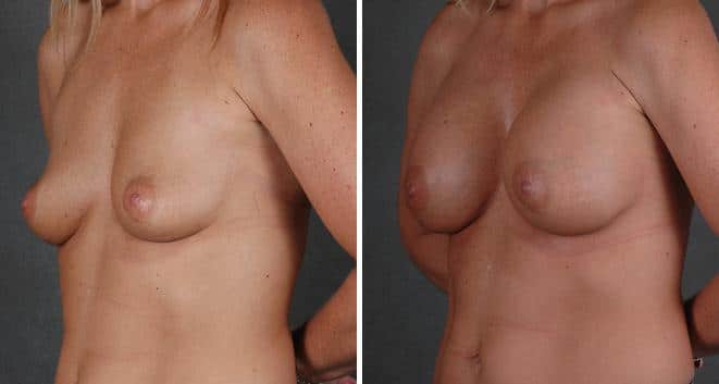 Breast Augmentation Before and After Photos in Omaha, NE, Case 3785