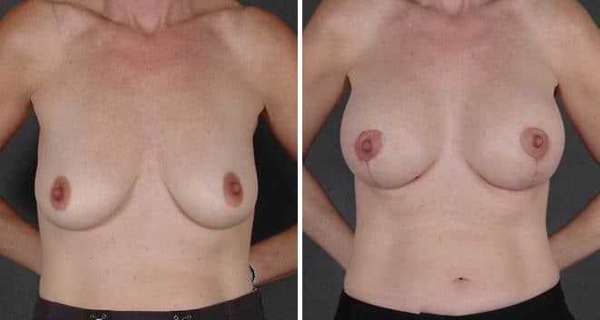 Breast Augmentation Before and After Photos in Omaha, NE, Case 3827