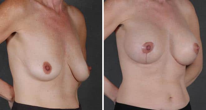 Breast Augmentation Before and After Photos in Omaha, NE, Case 3827