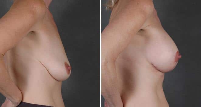 Breast Augmentation Before and After Photos in Omaha, NE, Case 3827