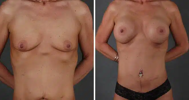 Breast Augmentation Before and After Photos in Omaha, NE, Case 3855