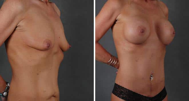 Breast Augmentation Before and After Photos in Omaha, NE, Case 3855