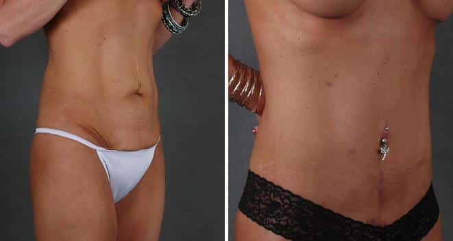 Breast Augmentation Before and After Photos in Omaha, NE, Case 3855