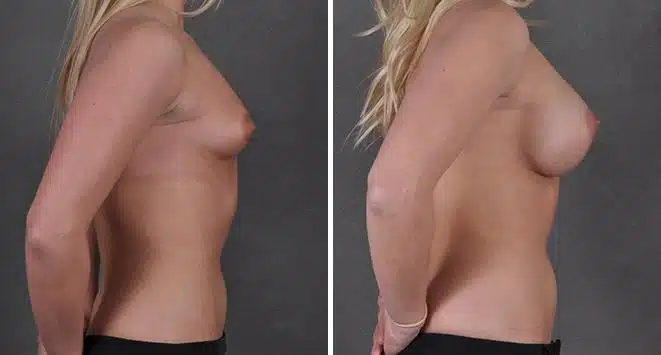 Breast Augmentation Before and After Photos in Omaha, NE, Case 3674