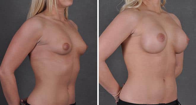 Breast Augmentation Before and After Photos in Omaha, NE, Case 3674