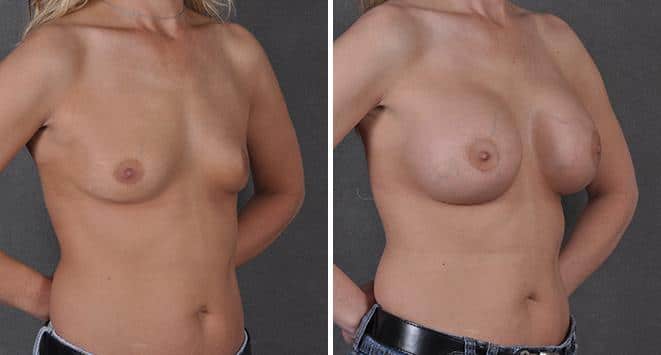 Breast Augmentation Before and After Photos in Omaha, NE, Case 3682