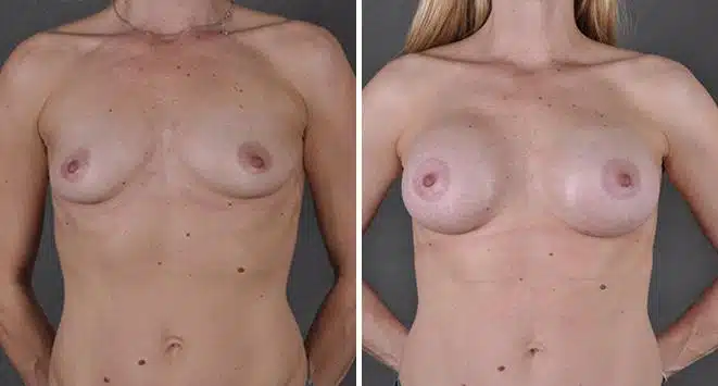 Breast Augmentation Before and After Photos in Omaha, NE, Case 3667