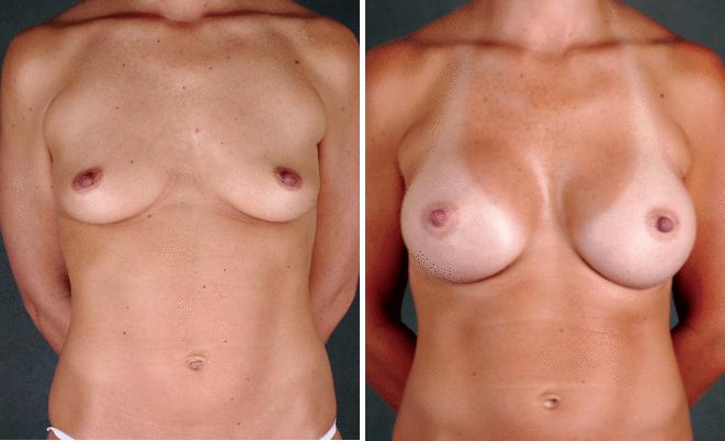 Liposuction Before and After Photos in Omaha, NE, Case 3808