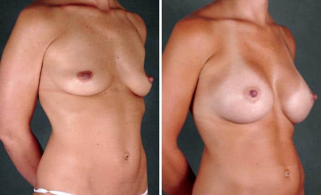 Liposuction Before and After Photos in Omaha, NE, Case 3808