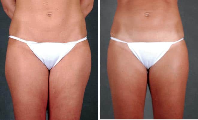 Liposuction Before and After Photos in Omaha, NE, Case 3808