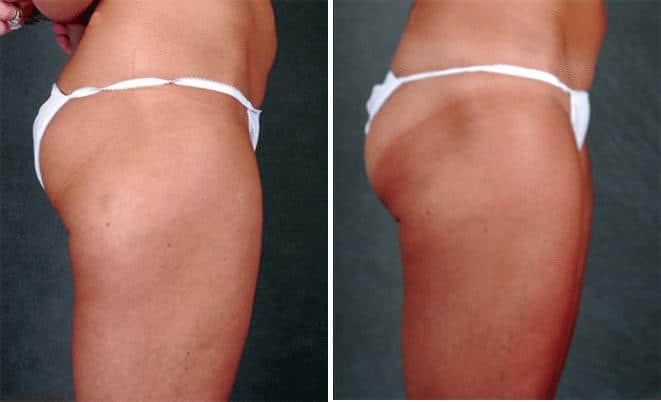 Liposuction Before and After Photos in Omaha, NE, Case 3808