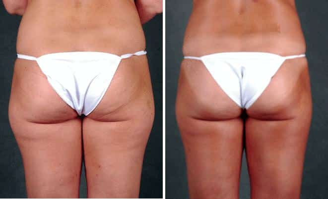 Liposuction Before and After Photos in Omaha, NE, Case 3808